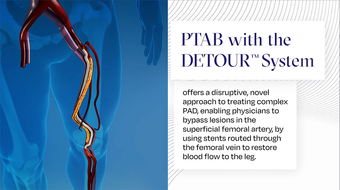Endologix receives FDA Approval of the DETOUR™ System to Treat Long Complex Superficial Femoropopliteal Lesions in Patients with PAD.